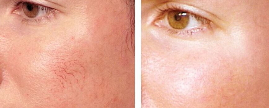 Rosacea pašalinimas