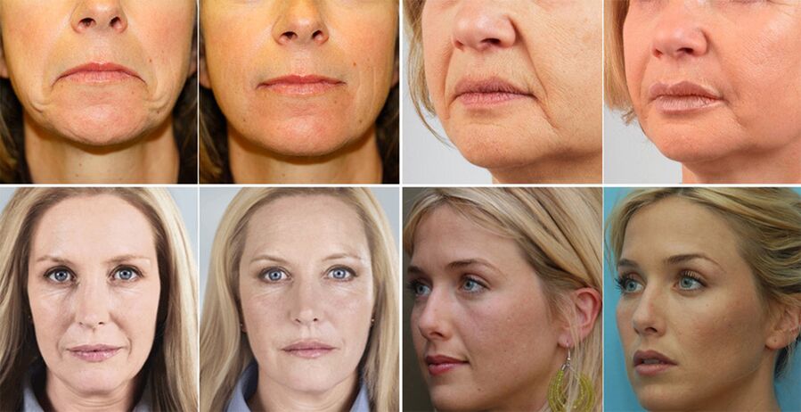 moterų nuotraukos prieš ir po veido odos atjauninimo